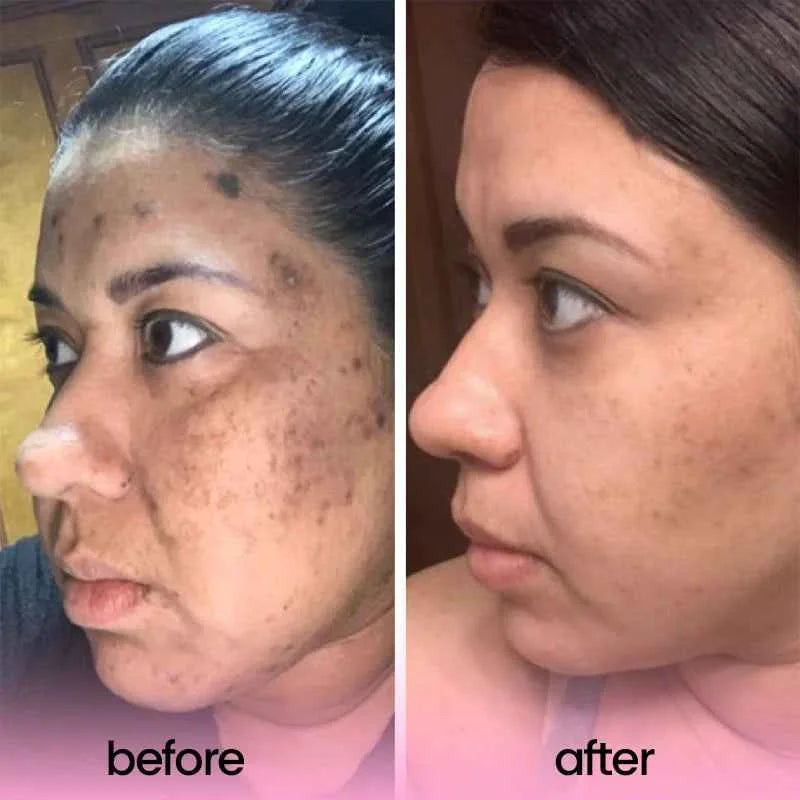 Turmeric and Kojic Acid Pads for Smooth Skin