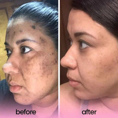 Turmeric and Kojic Acid Pads for Smooth Skin